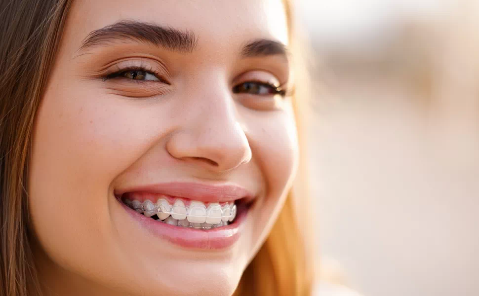Invisalign Clear Aligners