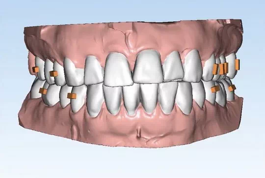 How does Invisalign work