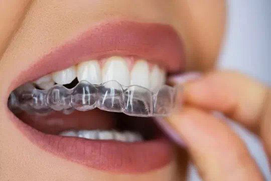 Invisalign is a popular solution